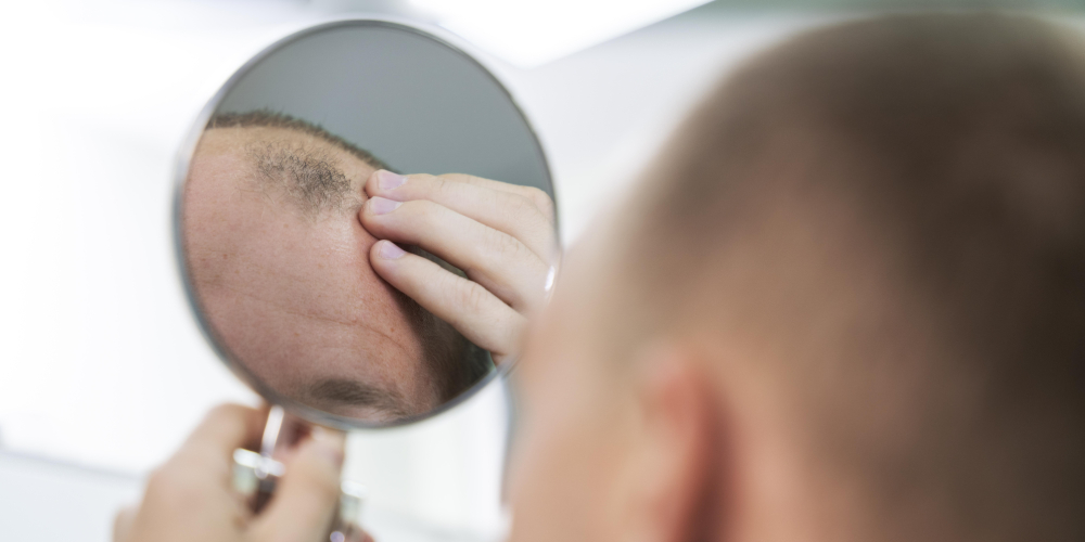 Can Smoking or Vaping Cause Hair Loss?